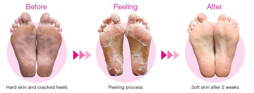 Softsole Express Exfoliating foot peel